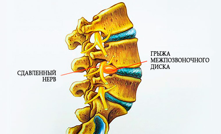Грыжа межпозвоночного диска - симптомы, причины, лечение